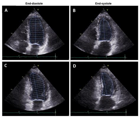 lv function ef|Assessing Left Ventricular Ejection Fraction With Echocardiography.